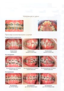 Ортодонтия – красивые зубы, голливудская улыбка