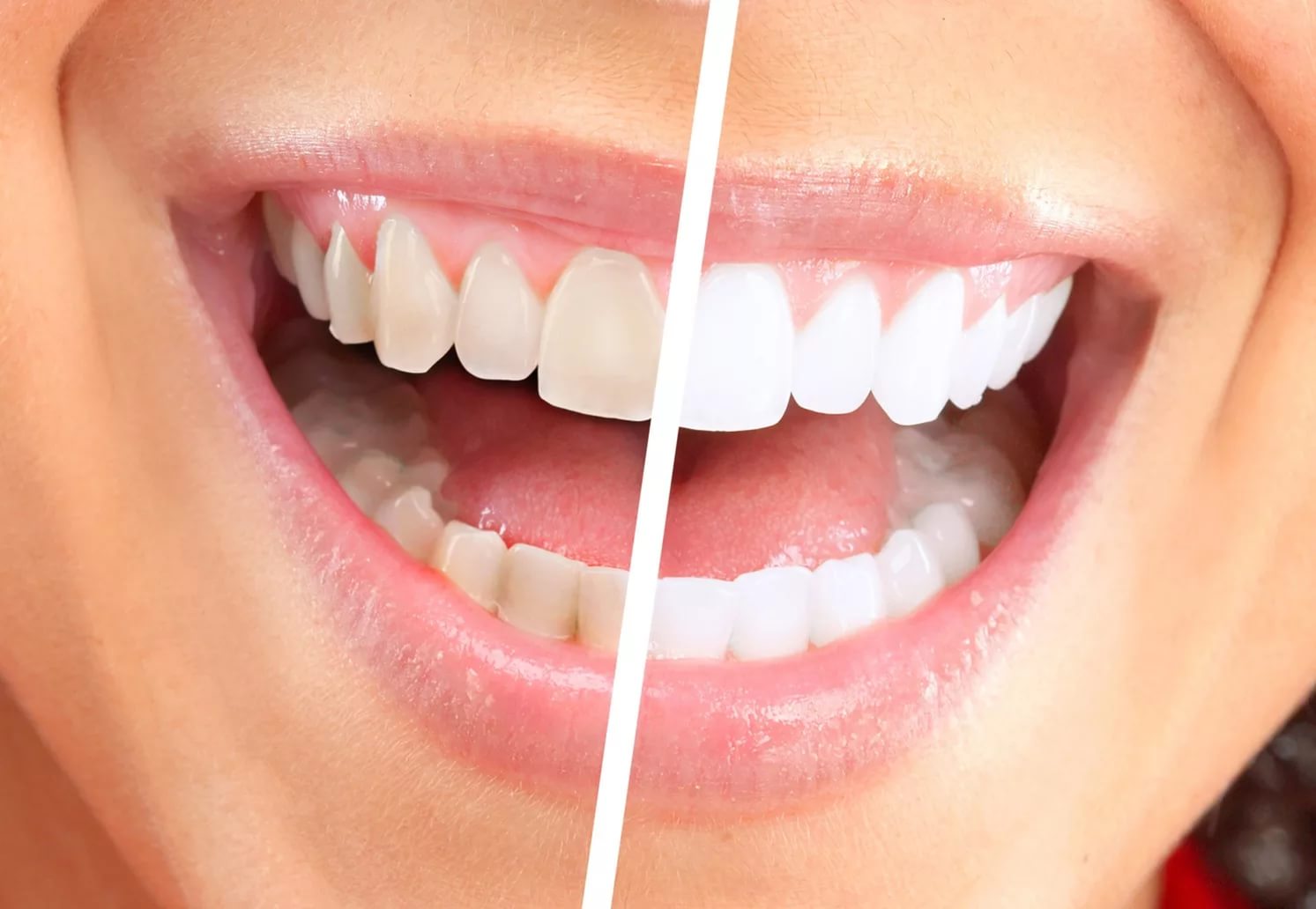 Вредно ли отбеливание зубов в стоматологии
